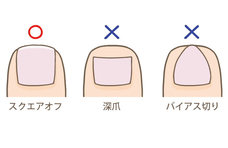 巻き爪| 千葉県富里市の巻き爪ならフットケアサロン・ポアント 成田市近郊